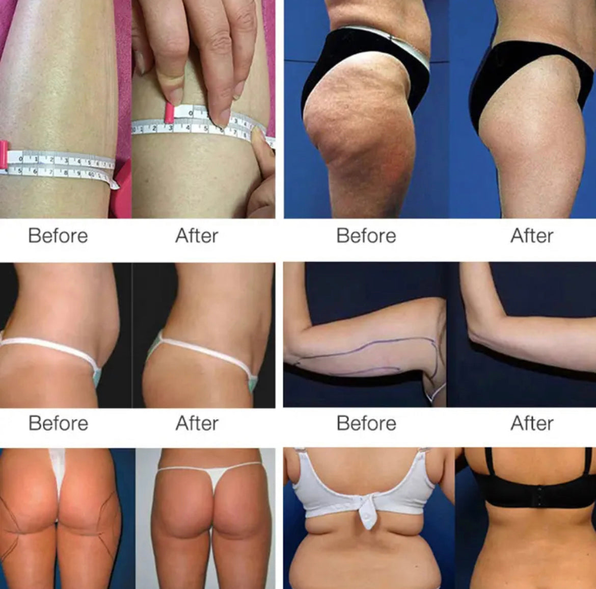 Traitement de Lipo Cavitation